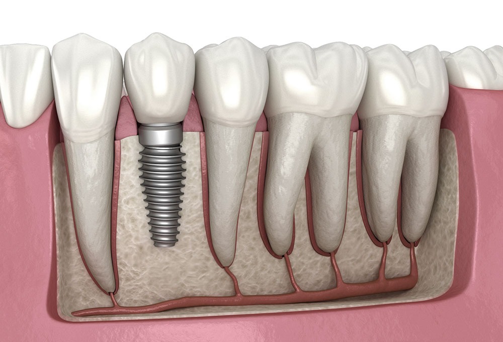 Advanced dental implant service at Whiteberry Dental Clinic